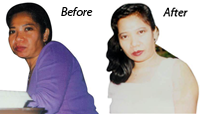 Cecilia Before - Youthfulness Aling with Beauty Achieved